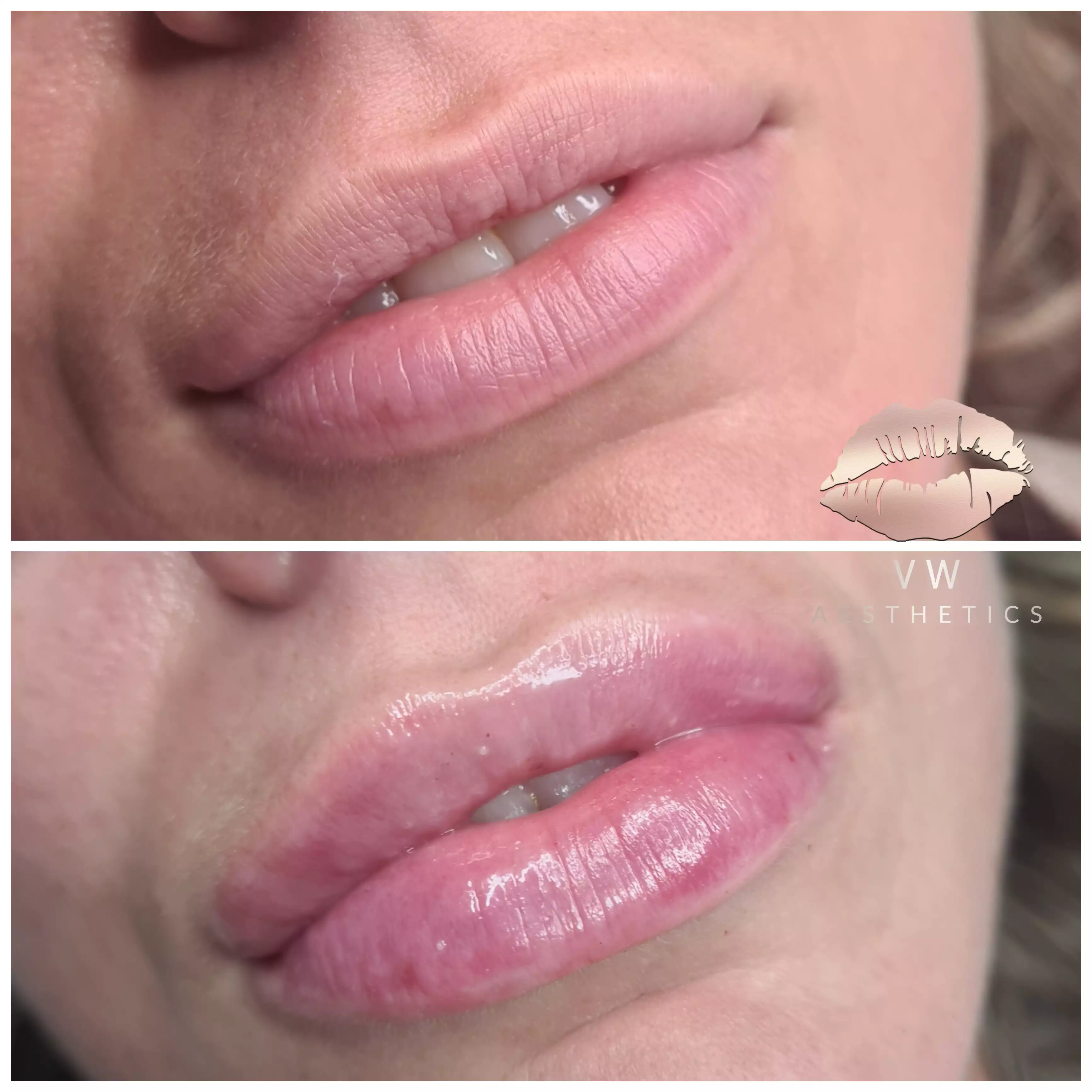 Jawline & Chin Contour - VW Aesthetics