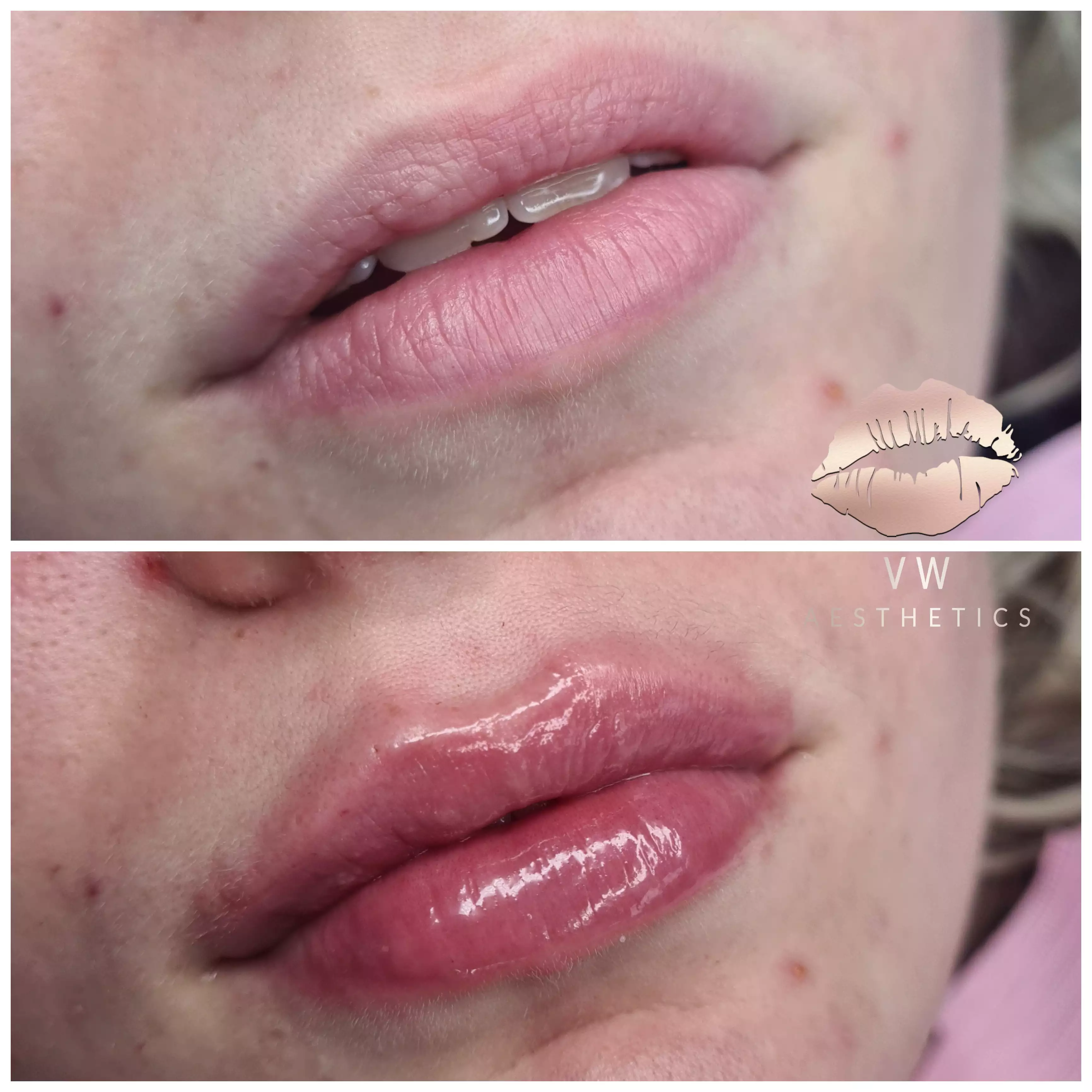 Jawline & Chin Contour - VW Aesthetics