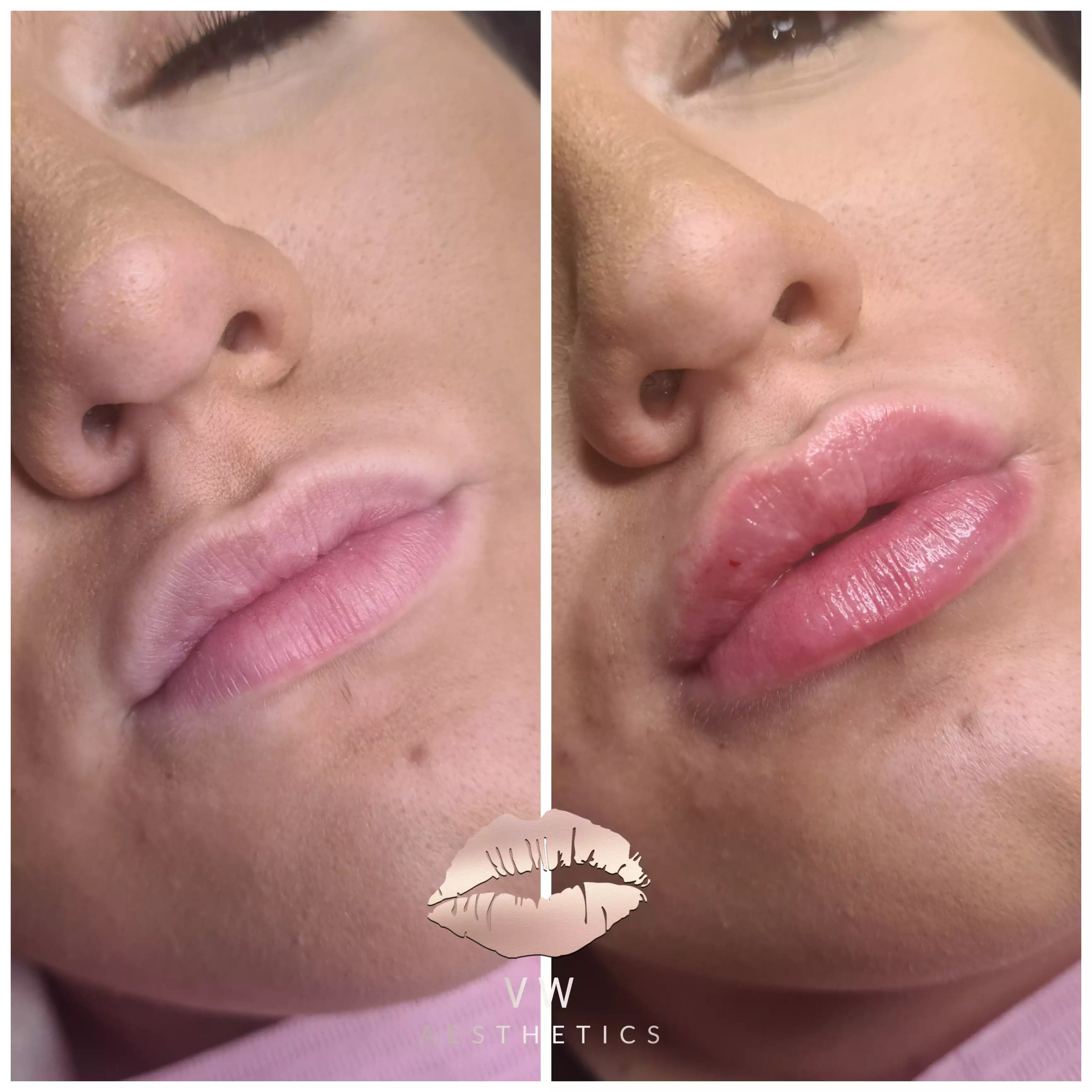 Jawline & Chin Contour - VW Aesthetics