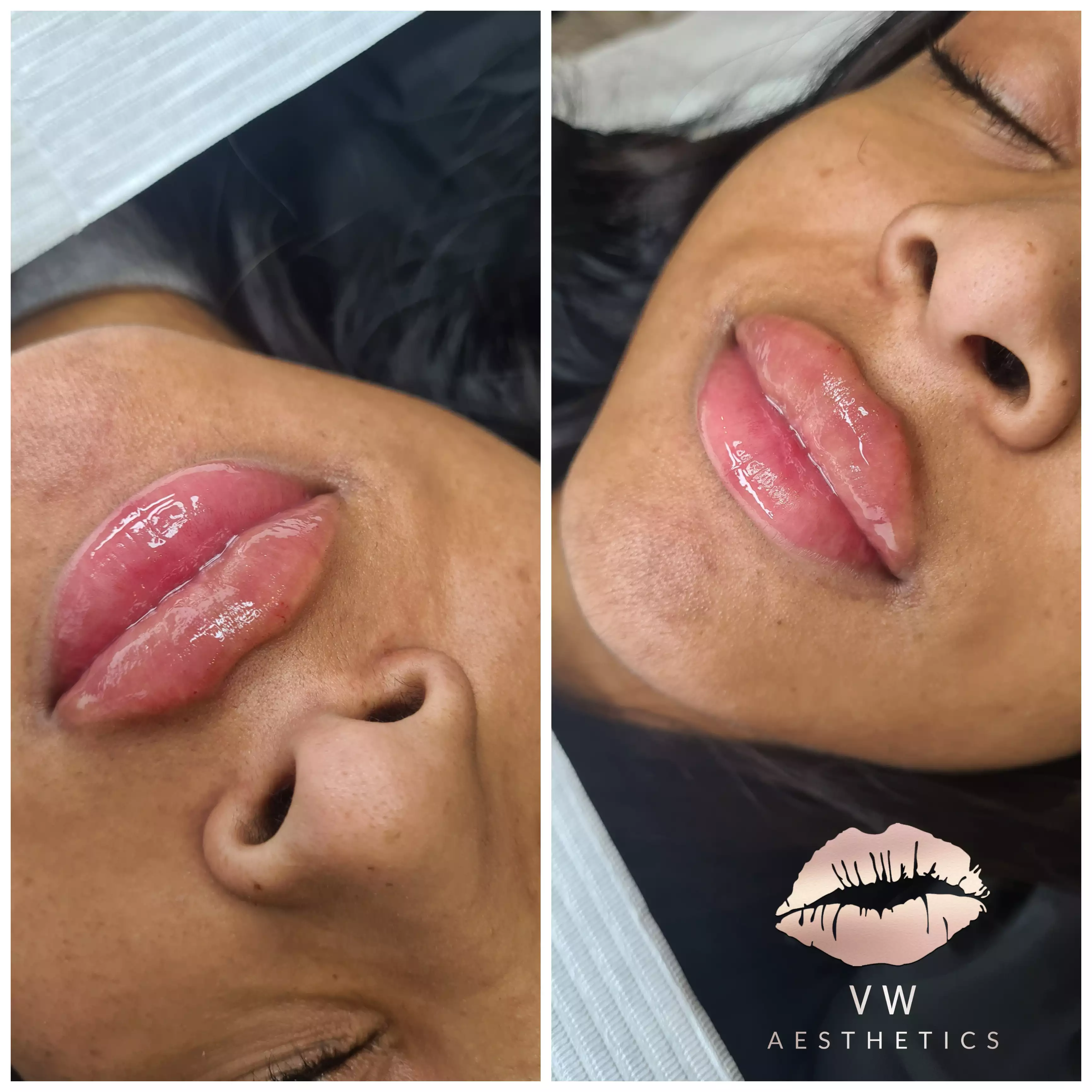 Jawline & Chin Contour - VW Aesthetics