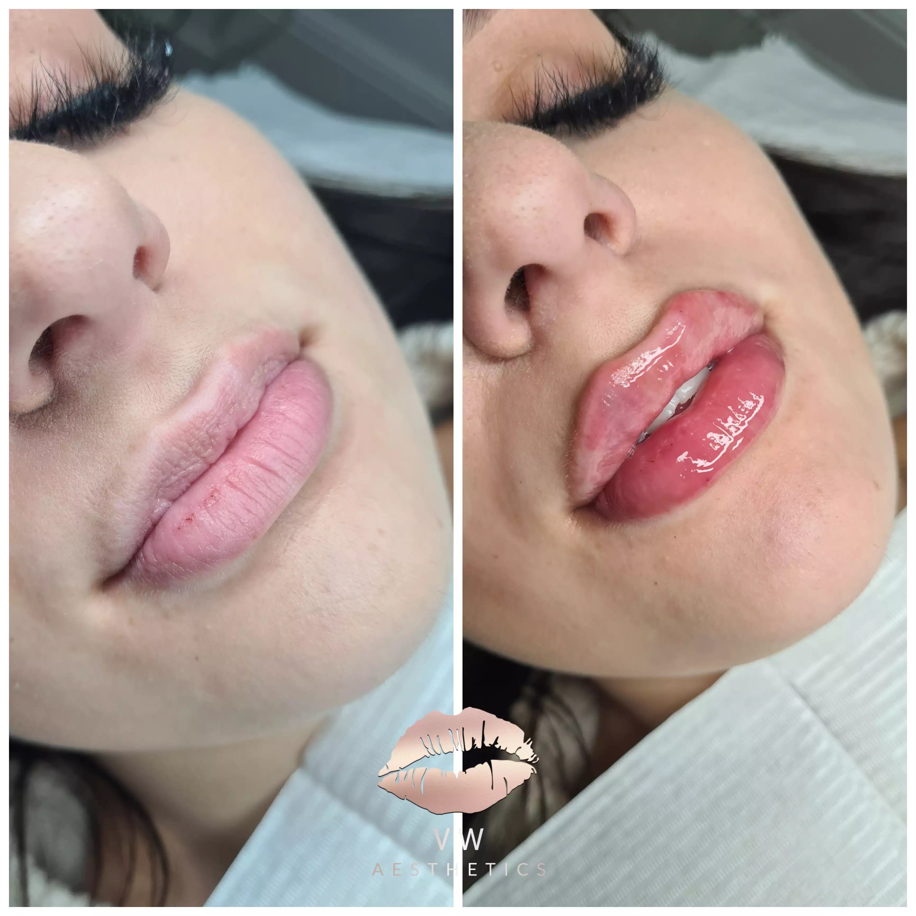 Jawline & Chin Contour - VW Aesthetics