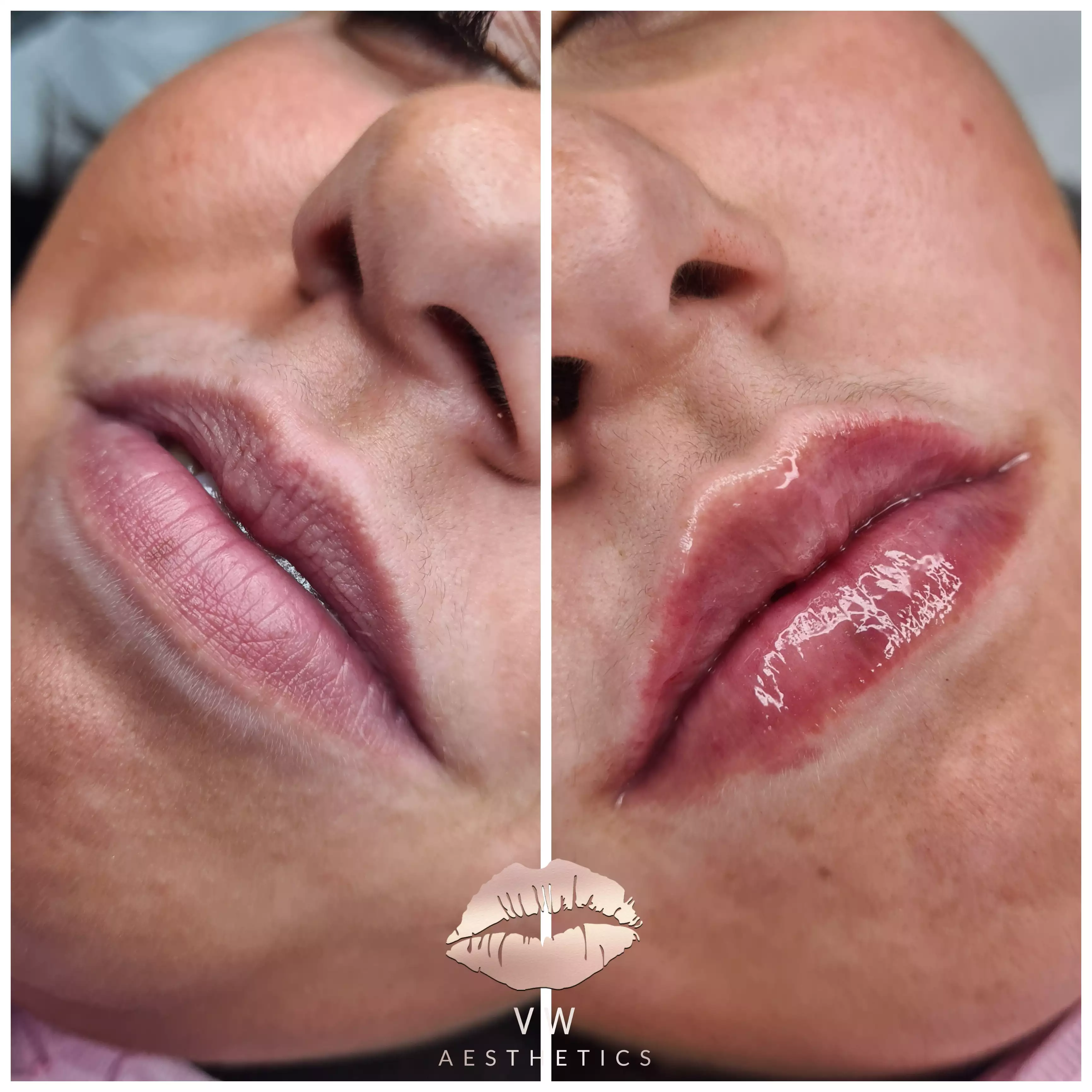 Jawline & Chin Contour - VW Aesthetics