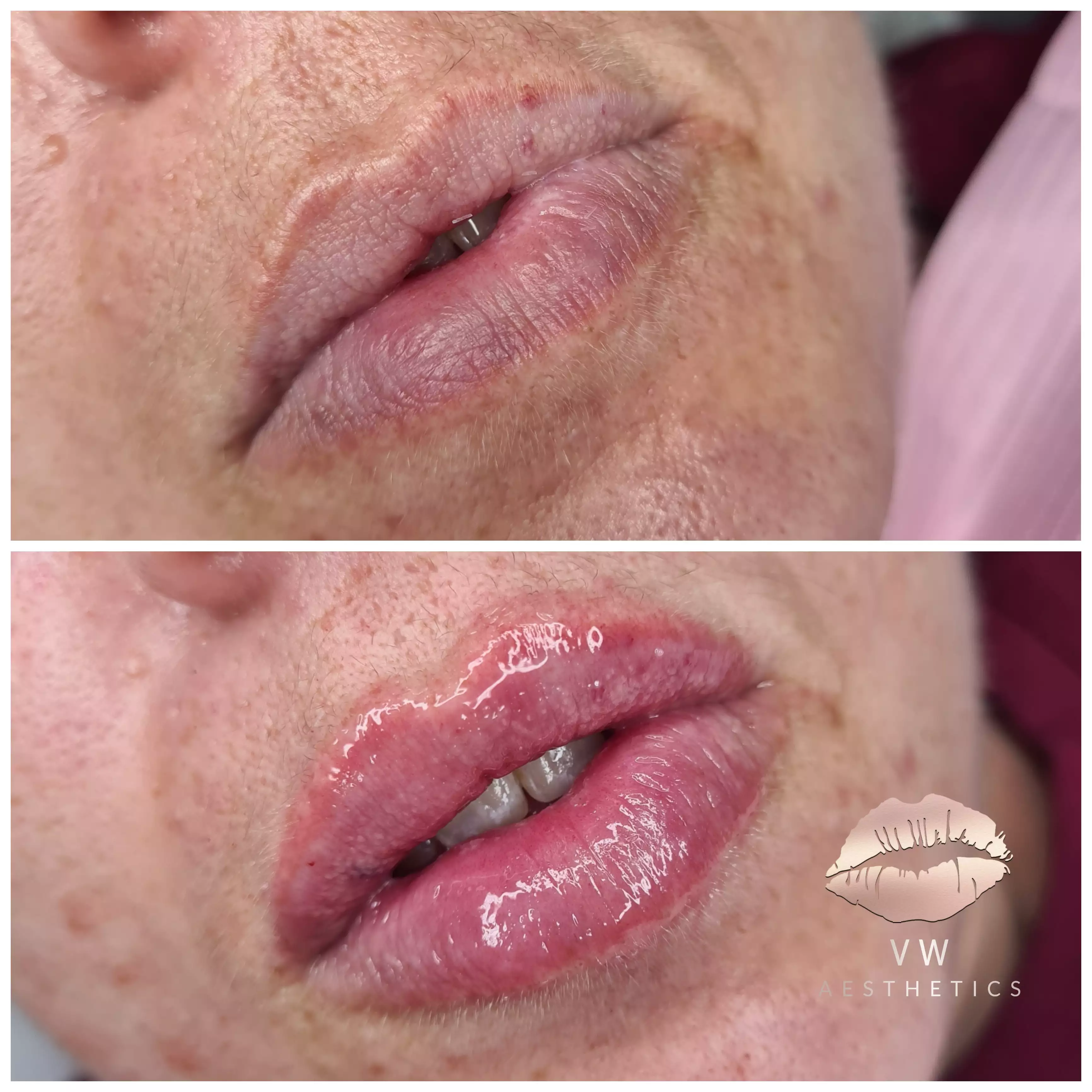 Jawline & Chin Contour - VW Aesthetics