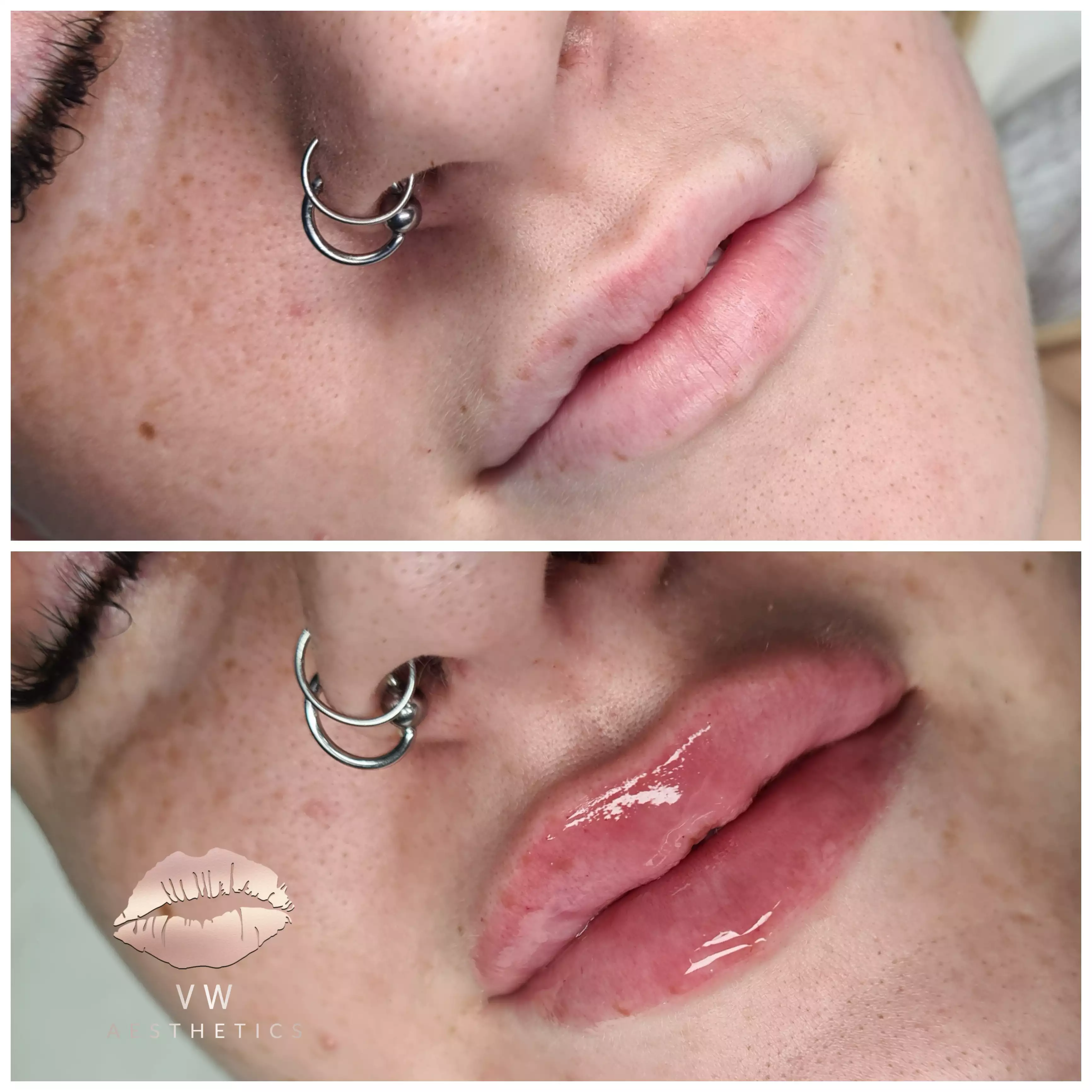 Jawline & Chin Contour - VW Aesthetics