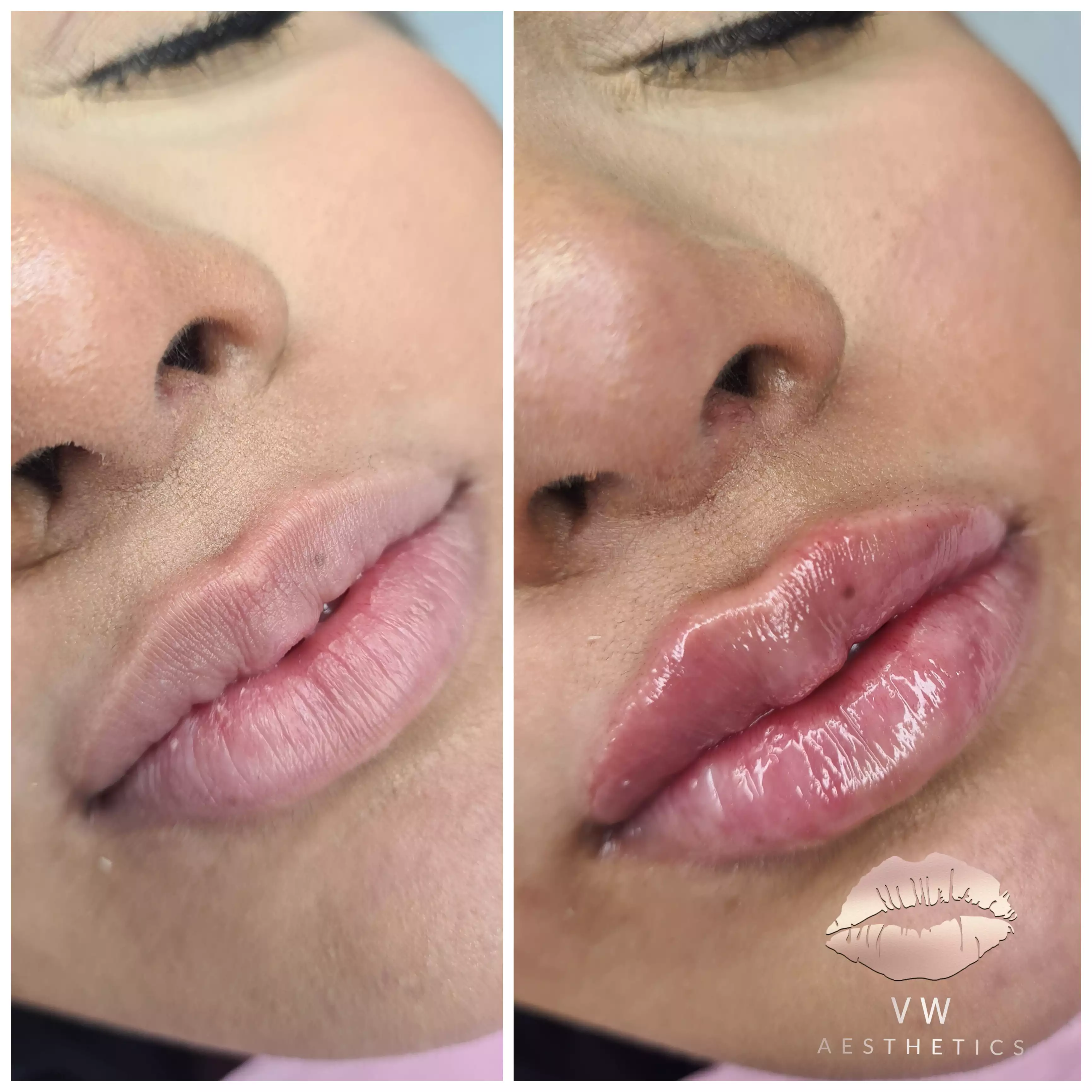 Jawline & Chin Contour - VW Aesthetics