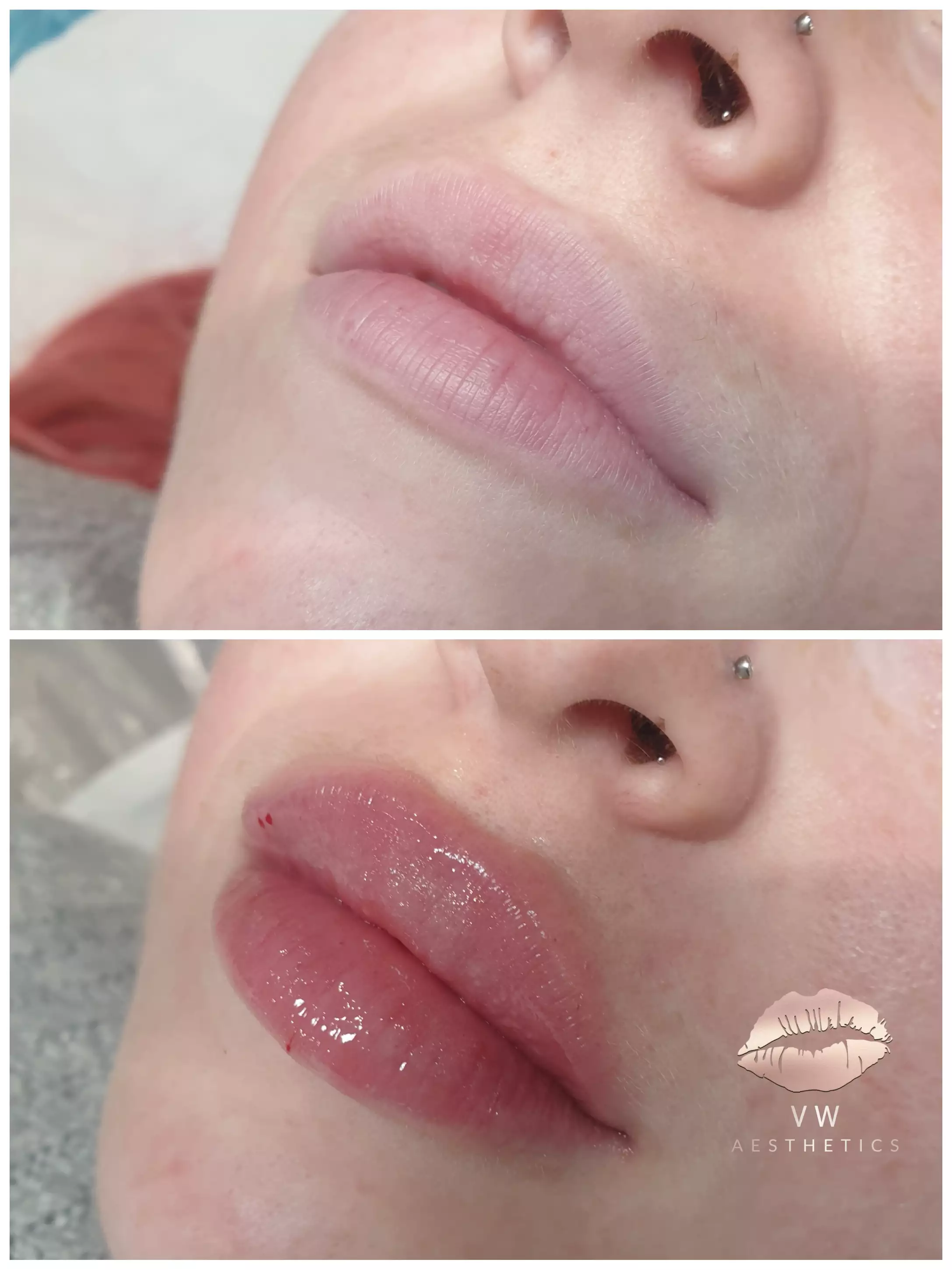 Jawline & Chin Contour - VW Aesthetics