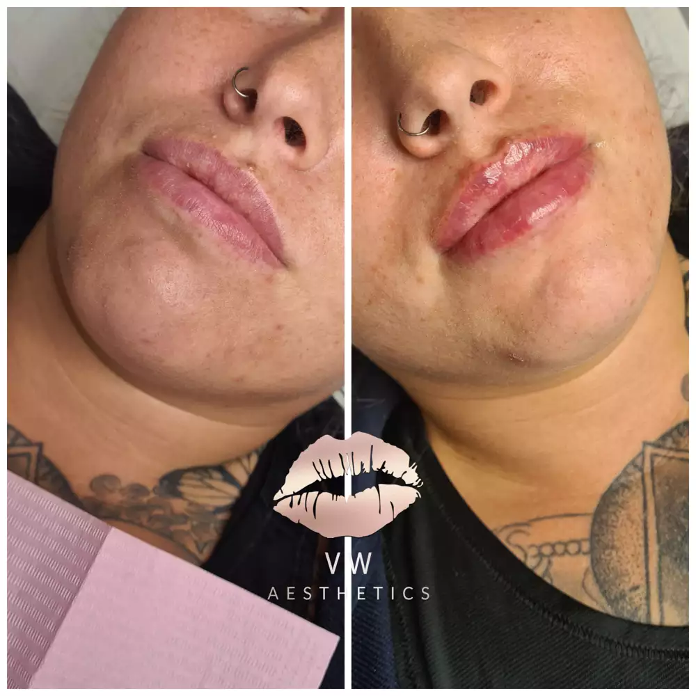 Jawline & Chin Contour - VW Aesthetics