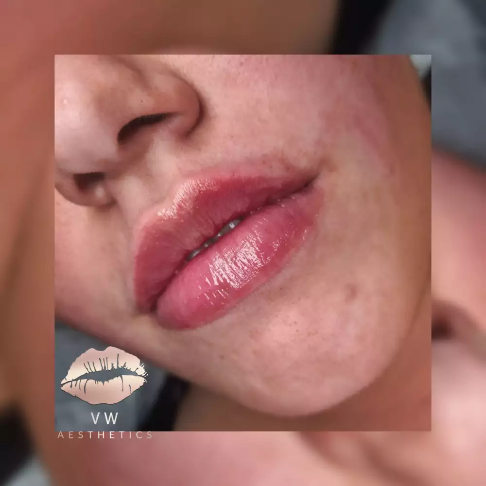 Jawline & Chin Contour - VW Aesthetics