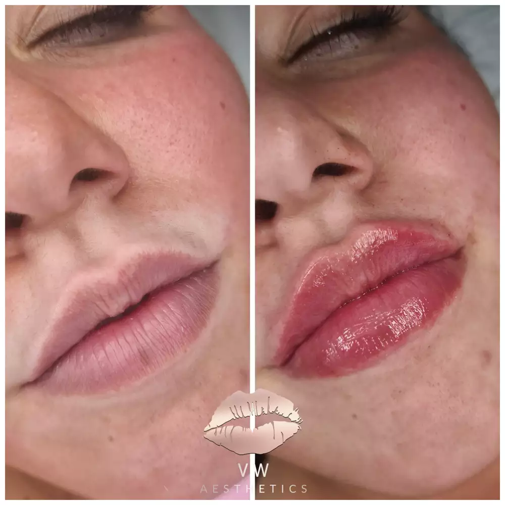 Jawline & Chin Contour - VW Aesthetics