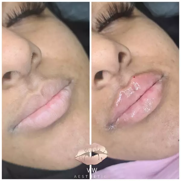 Jawline & Chin Contour - VW Aesthetics