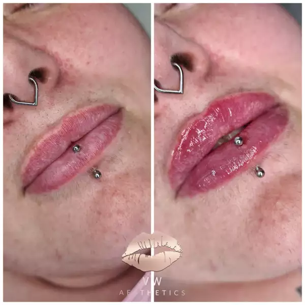 Jawline & Chin Contour - VW Aesthetics