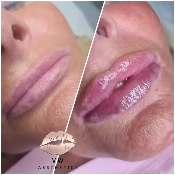 Jawline & Chin Contour - VW Aesthetics