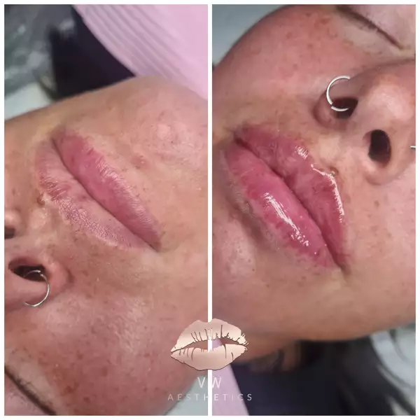 Jawline & Chin Contour - VW Aesthetics