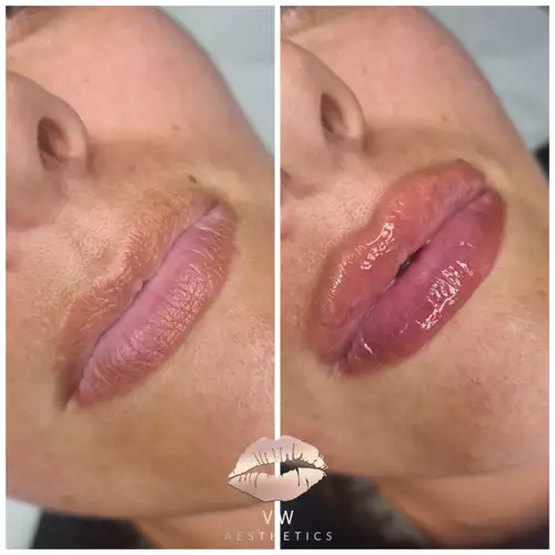 Jawline & Chin Contour - VW Aesthetics