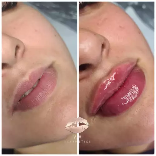 Jawline & Chin Contour - VW Aesthetics