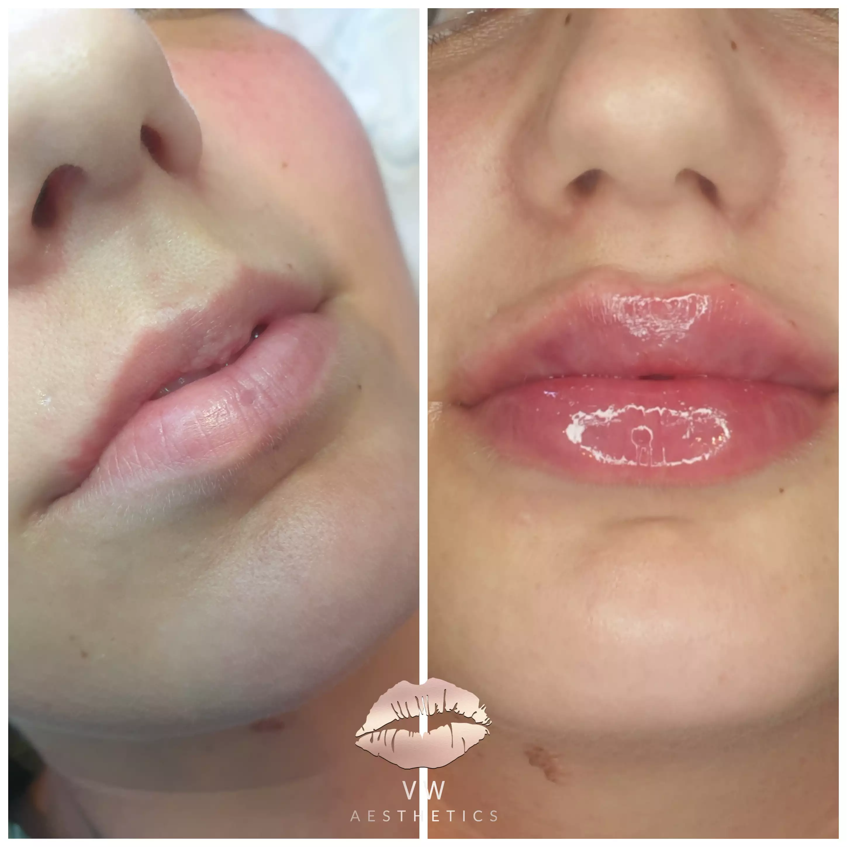 Jawline & Chin Contour - VW Aesthetics