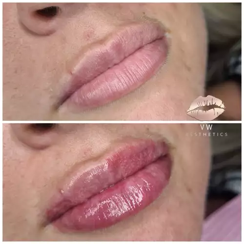 Jawline & Chin Contour - VW Aesthetics