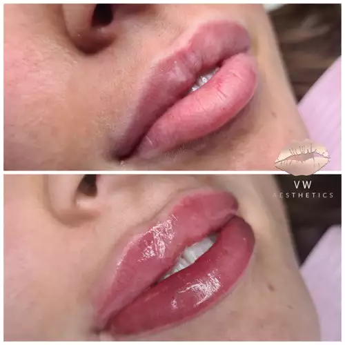 Jawline & Chin Contour - VW Aesthetics