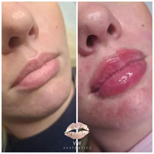 Jawline & Chin Contour - VW Aesthetics