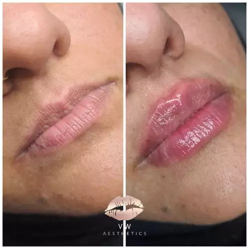 Jawline & Chin Contour - VW Aesthetics