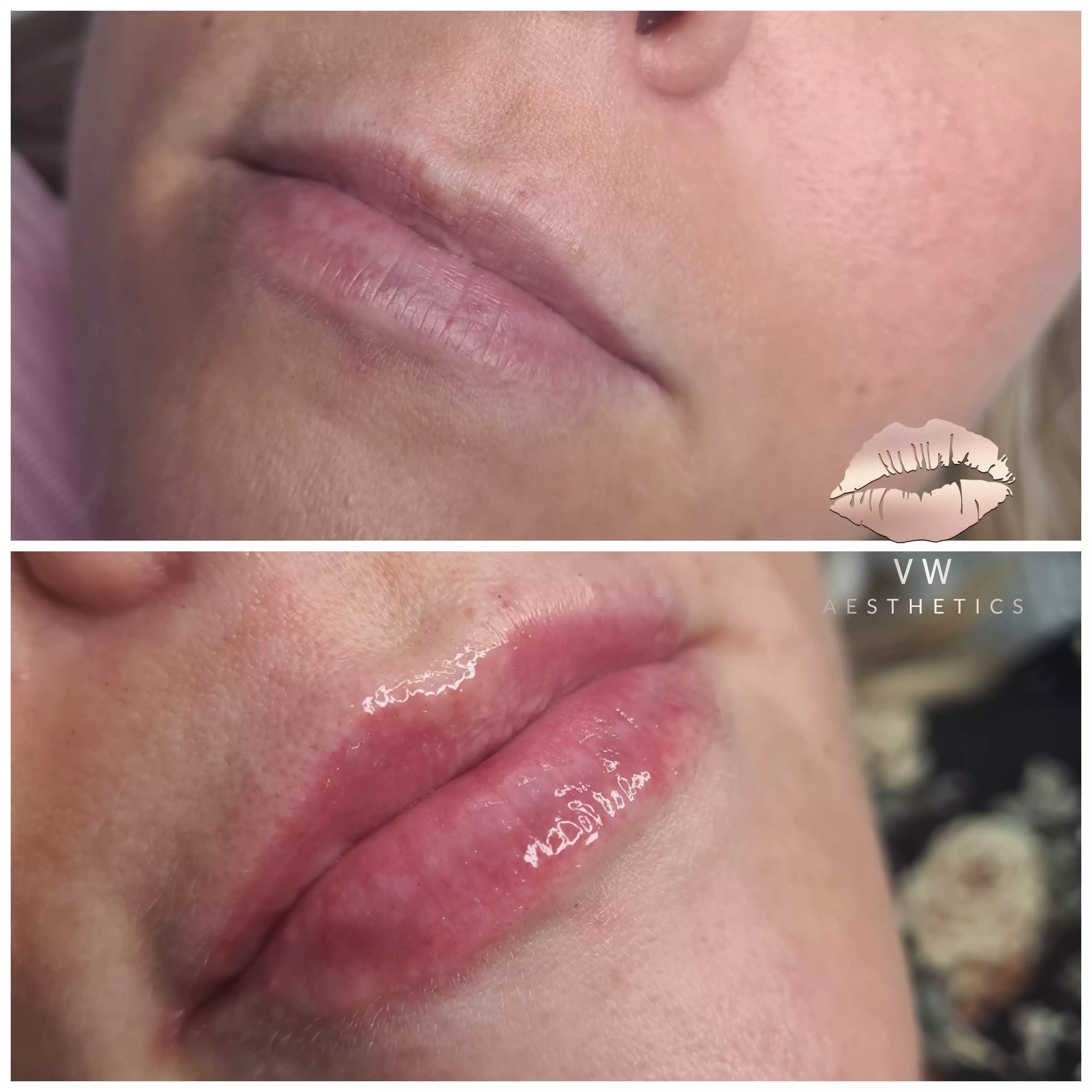 Jawline & Chin Contour - VW Aesthetics
