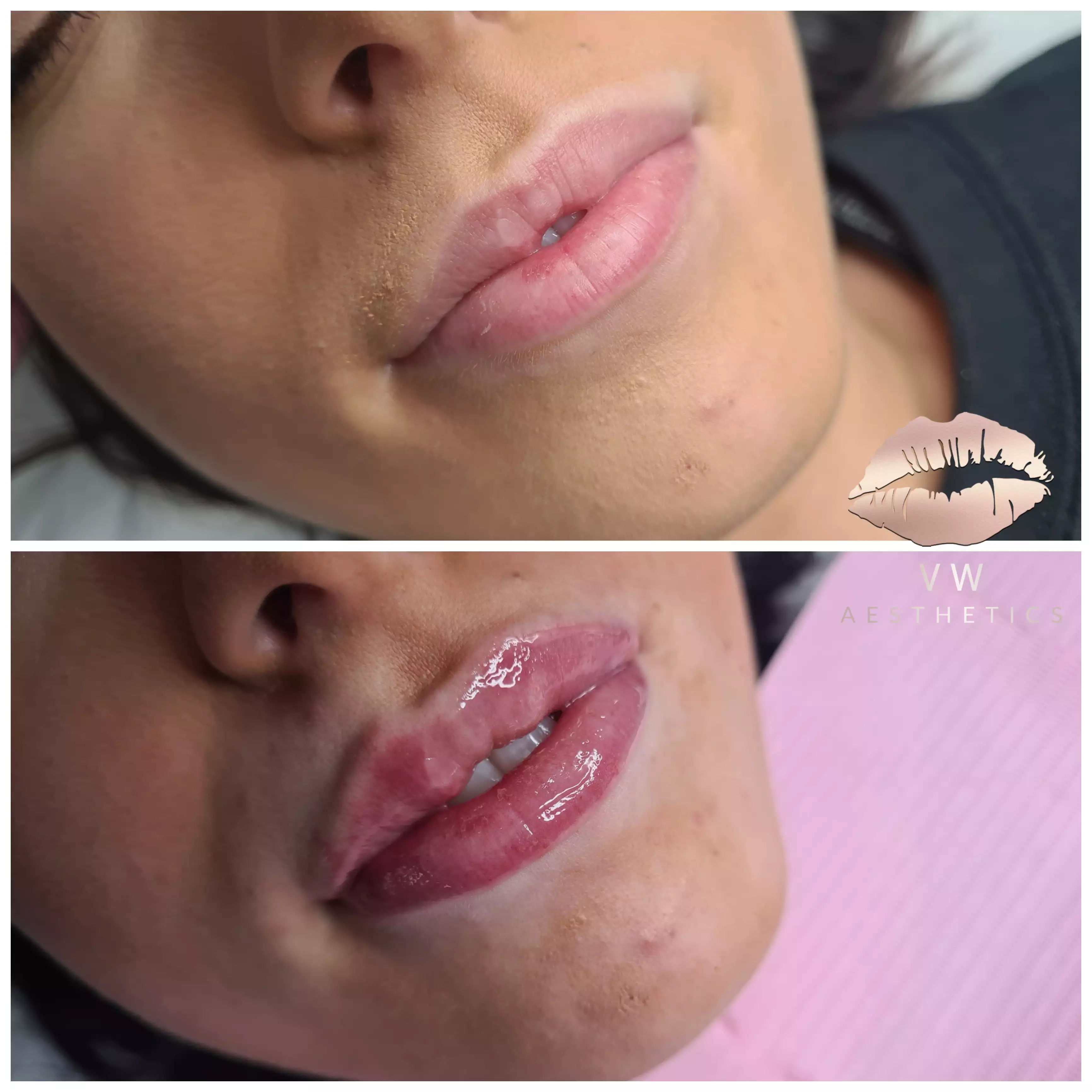 Jawline & Chin Contour - VW Aesthetics