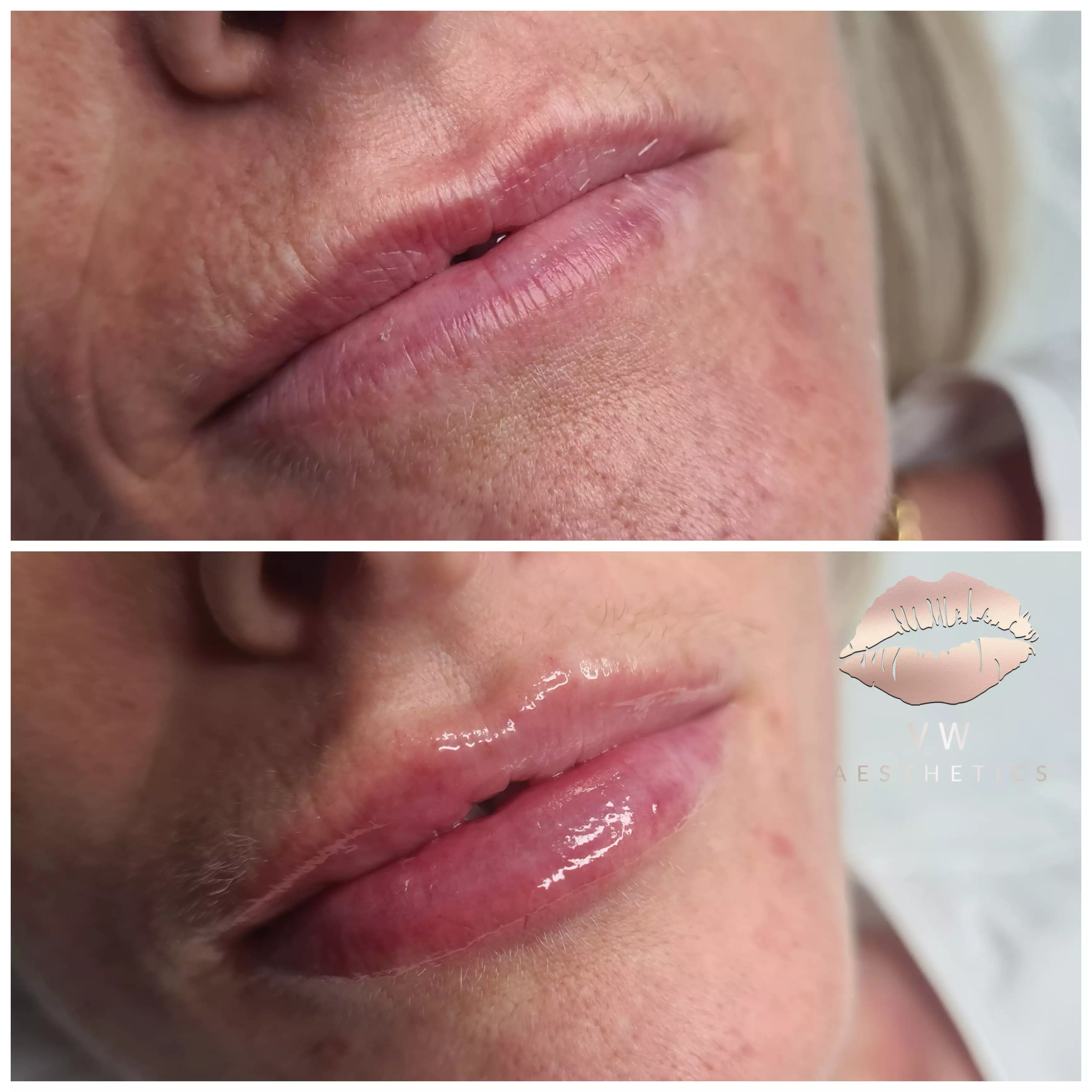 Jawline & Chin Contour - VW Aesthetics