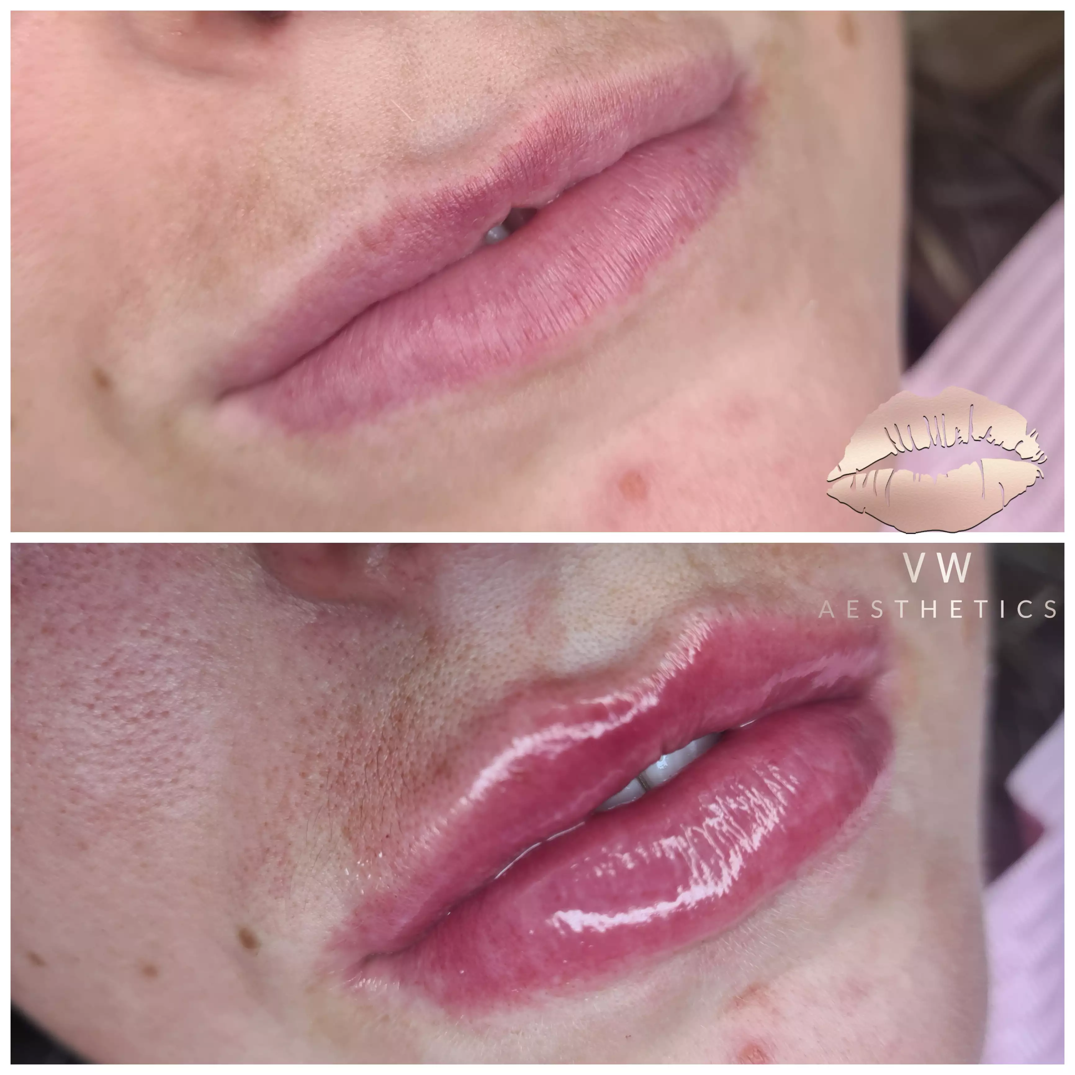 Jawline & Chin Contour - VW Aesthetics