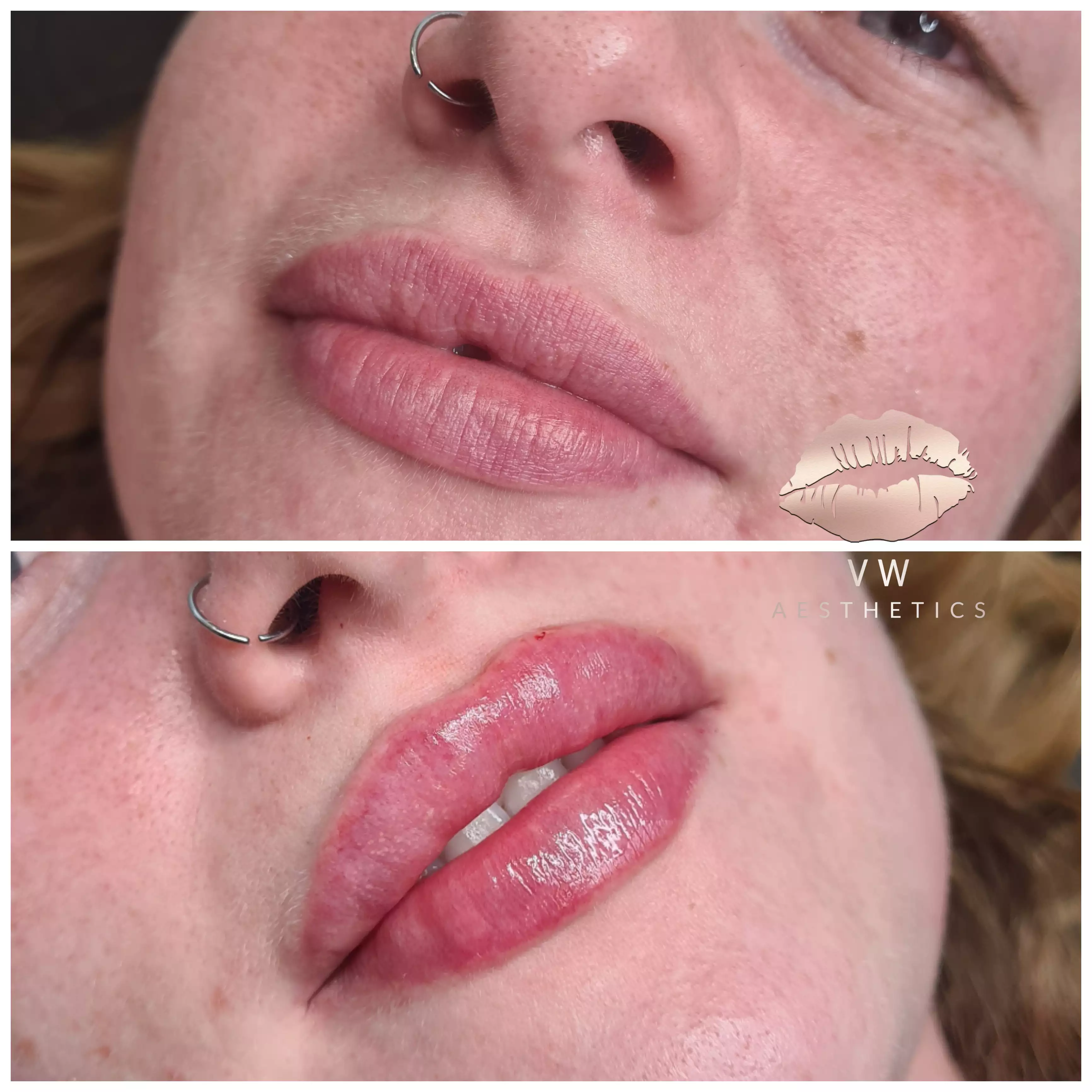 Jawline & Chin Contour - VW Aesthetics